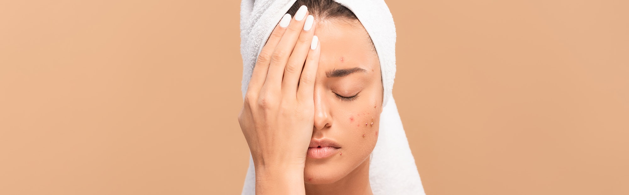 panoramic shot of girl with acne covering face isolated on beige